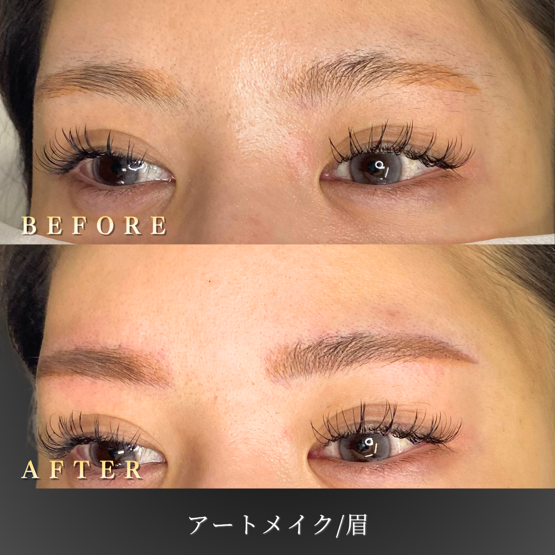 左45度 施術前後の比較写真