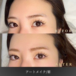 20代 眉アートメイク 症例写真〔左45度Before_After〕｜大阪 心斎橋BiBiクリニック
