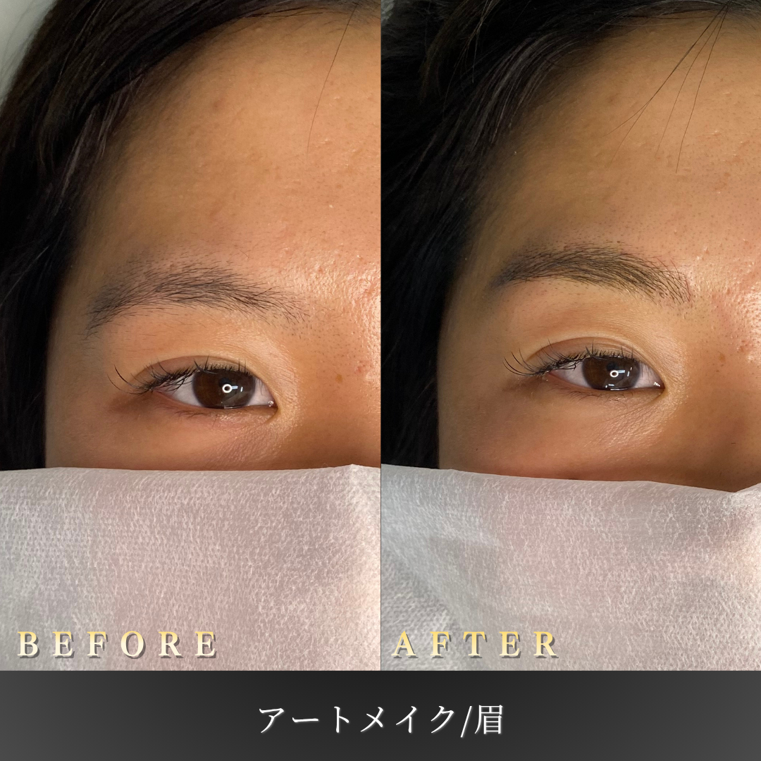 20代女性 眉アートメイク施術前後のBefore/After写真（正面撮影）