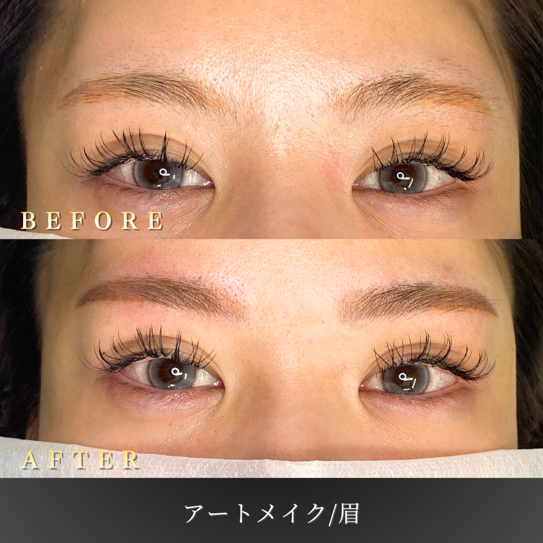 【20代女性】眉の左右差を整える眉アートメイク症例｜大阪 心斎橋BiBiクリニックの症例写真