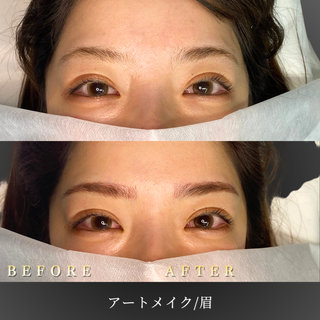 20代女性の眉アートメイク施術前後の正面写真