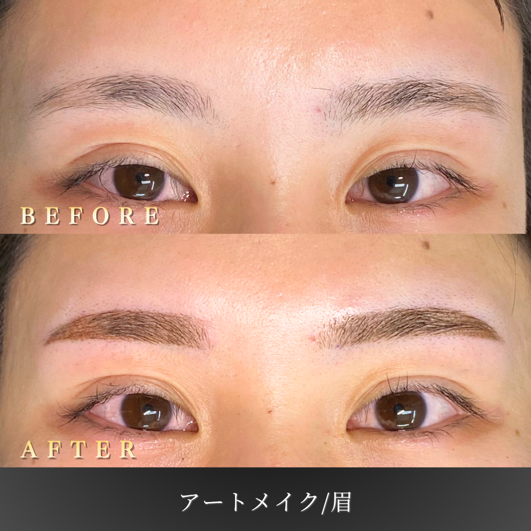 【20代女性】アーチ眉に整える眉アートメイク症例｜大阪 心斎橋BiBiクリニックの症例写真
