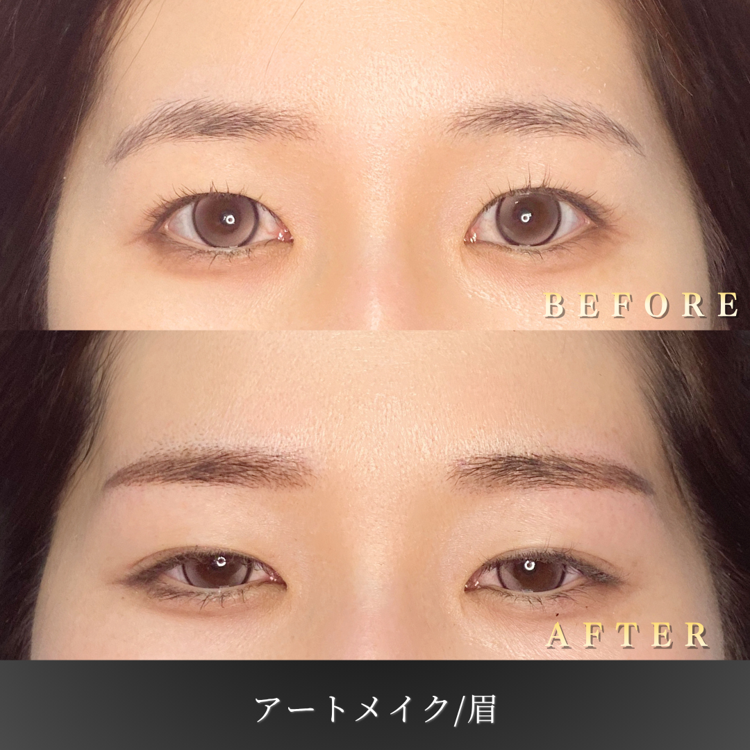 【20代女性】汗でも消えにくい眉アートメイク症例｜大阪 心斎橋BiBiクリニックの症例写真