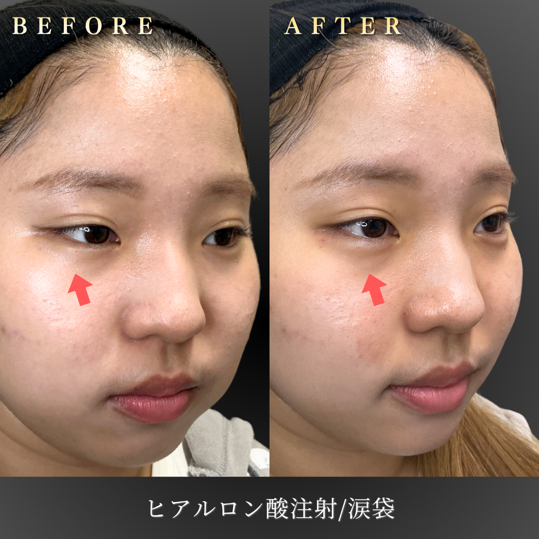 【20代女性】目元の印象を明るくする涙袋ヒアルロン酸症例｜大阪 心斎橋BiBiクリニックの症例写真