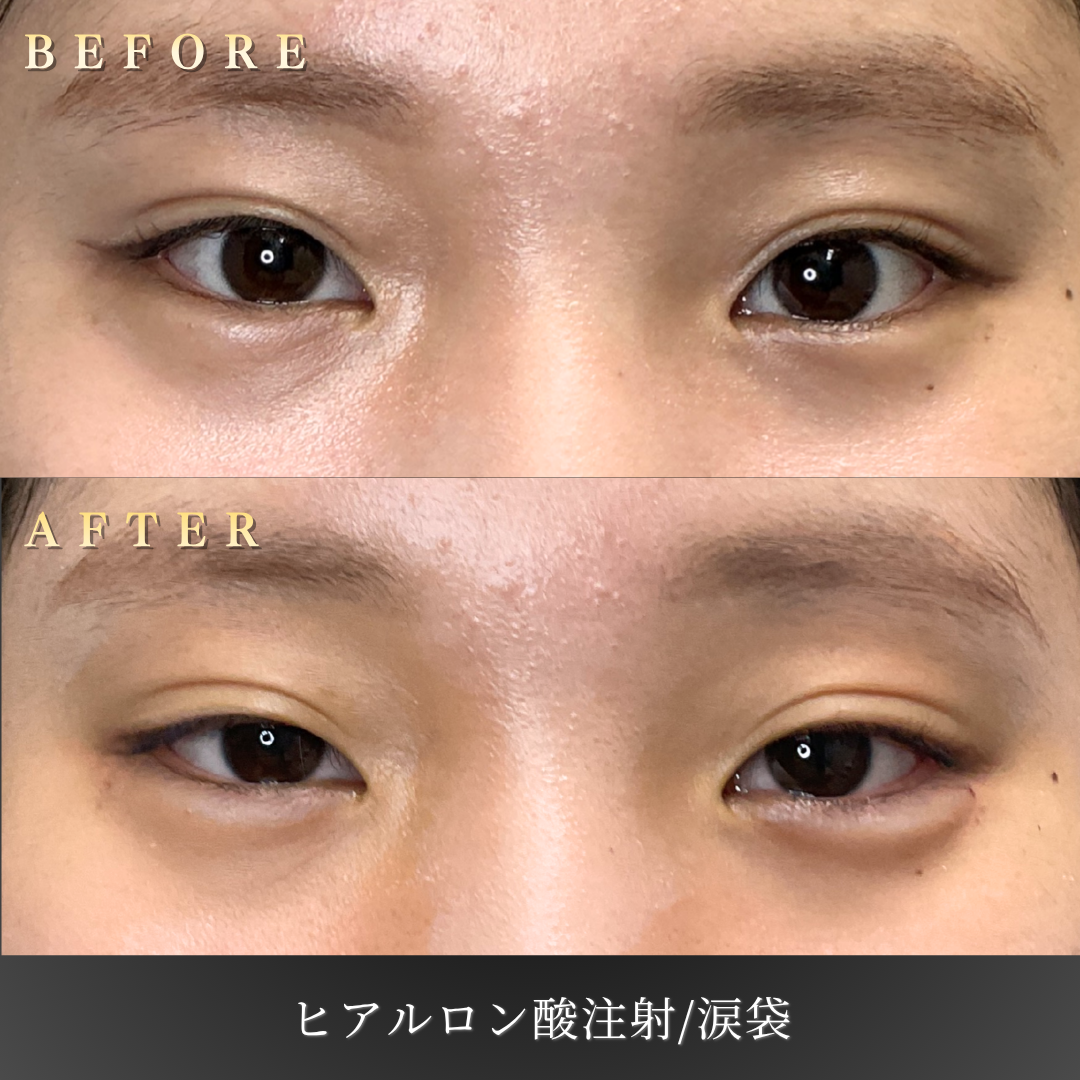 20代女性の涙袋 施術後の側面写真