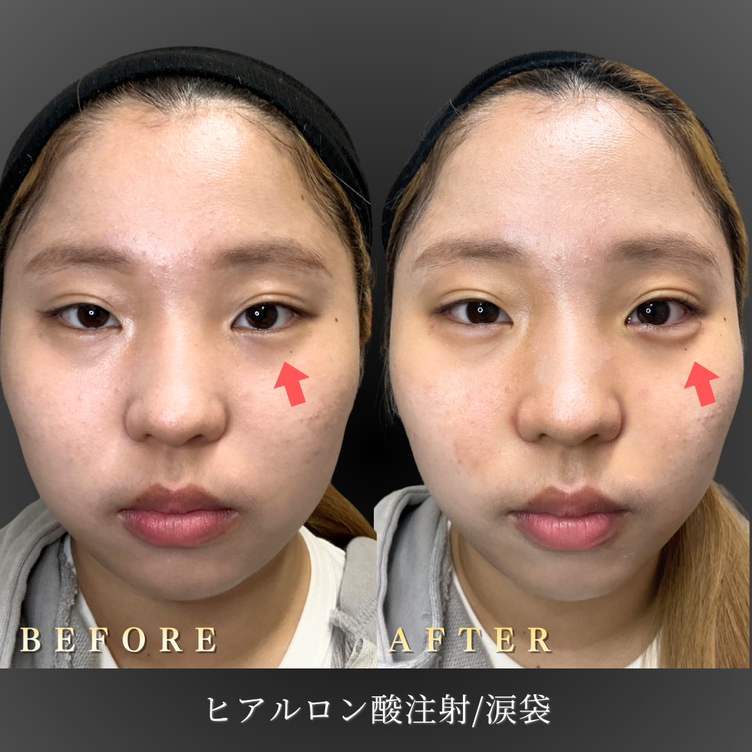 20代女性の涙袋 施術前のアップ写真