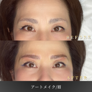 50代 眉アートメイク 症例写真〔正面Before_After〕｜大阪 心斎橋BiBiクリニック