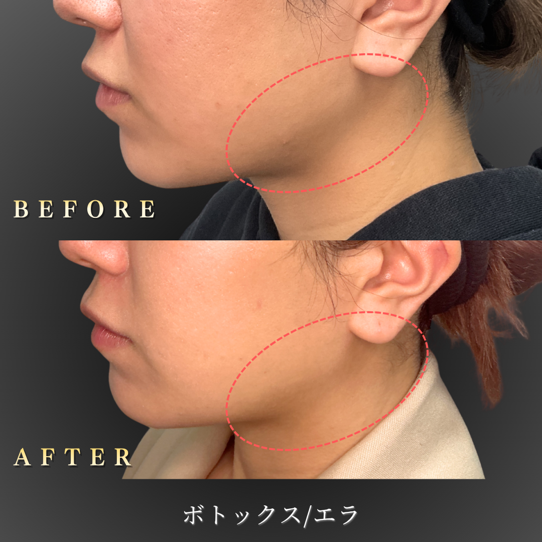 10代女性エラボトックス症例写真（右横 Before/After）｜大阪・心斎橋BiBiクリニック