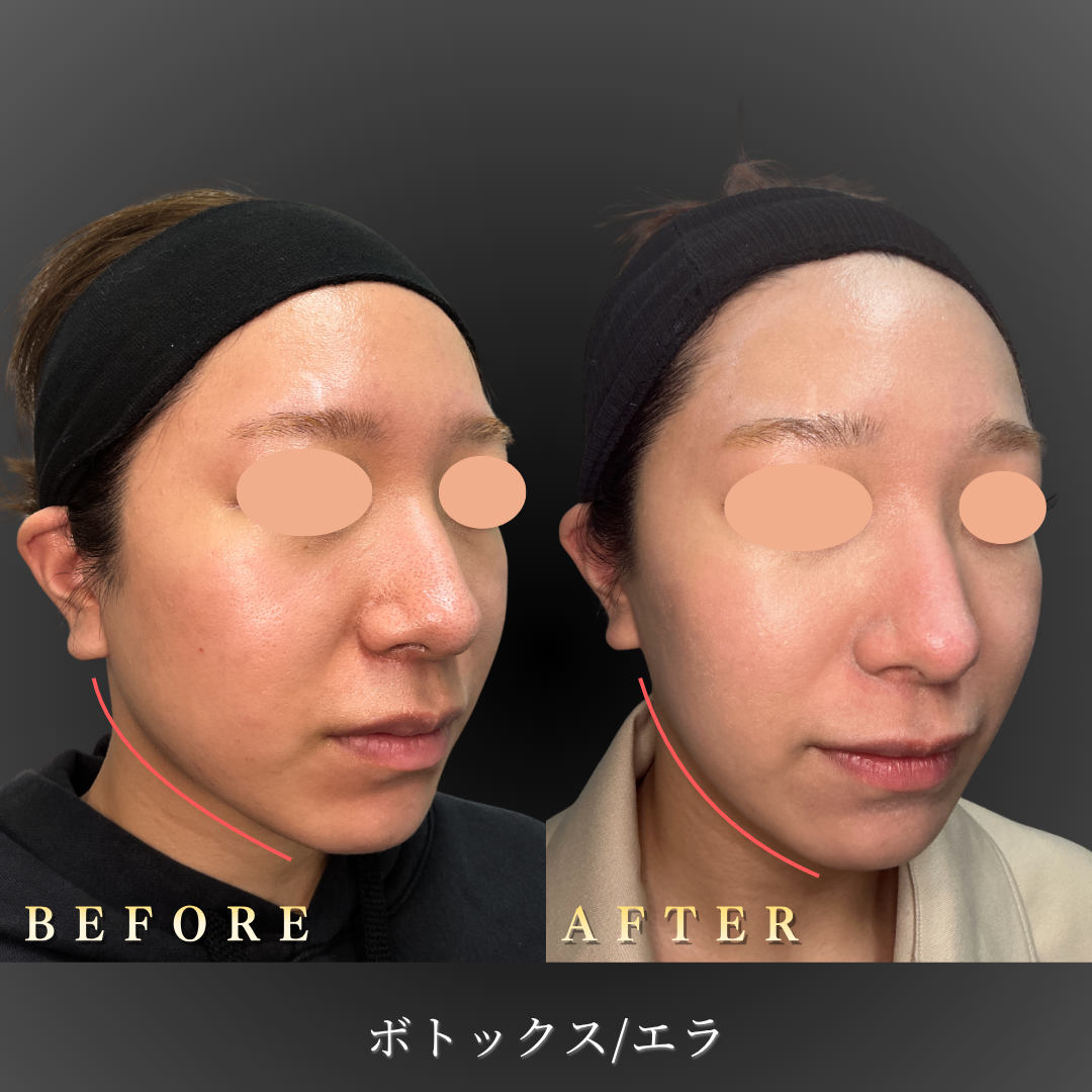 10代女性エラボトックス症例写真（右斜め Before/After）｜大阪・心斎橋BiBiクリニック