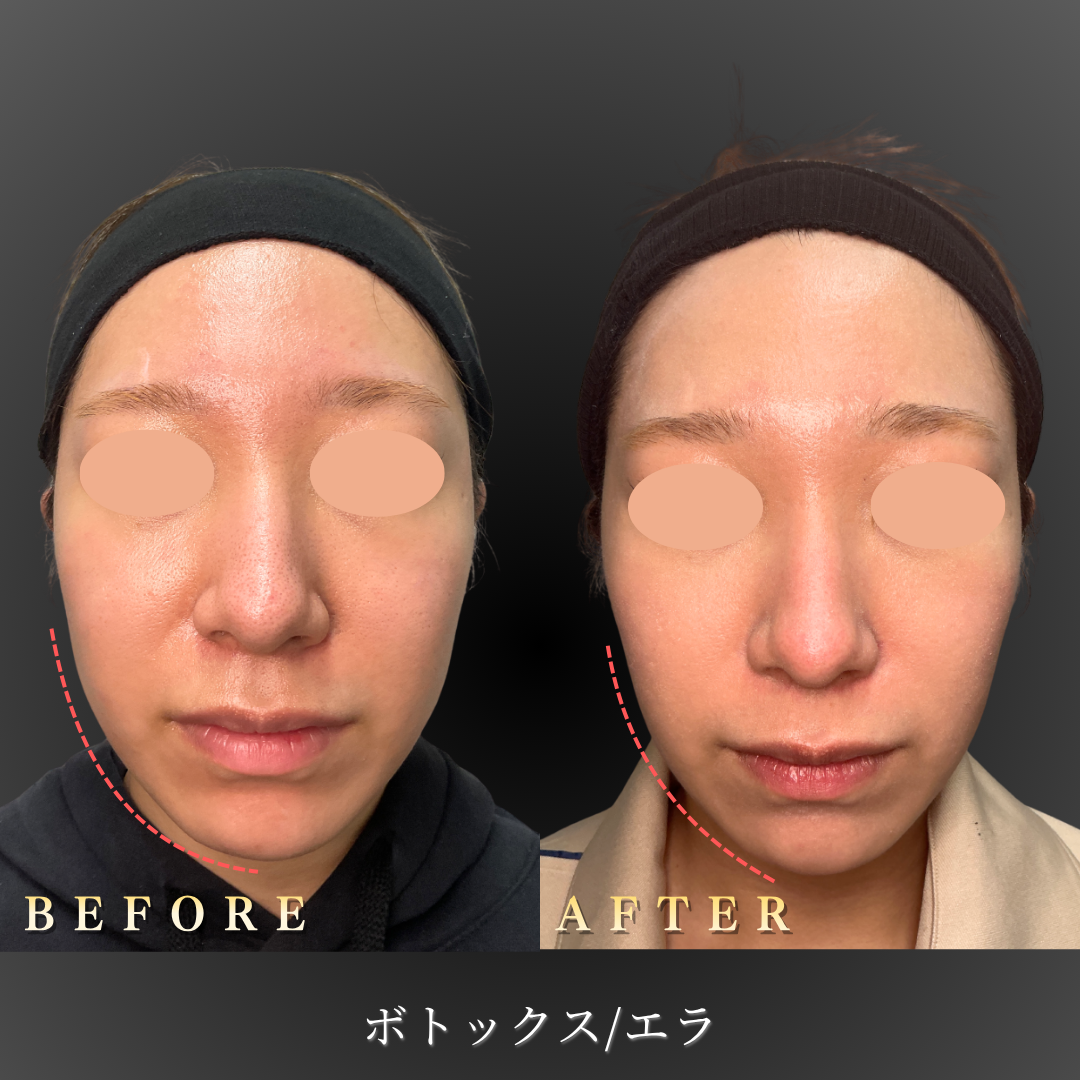 【10代女性】エラ・肩ボトックスで小顔＆引き締め｜大阪・心斎橋BiBiクリニックの症例写真