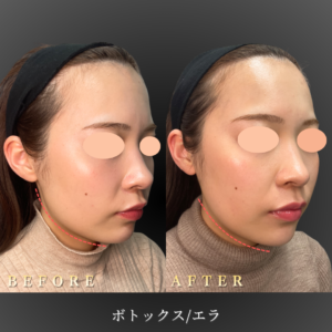 20代-エラボトックス-症例写真〔右45度Before_After〕｜大阪-心斎橋BiBiクリニック