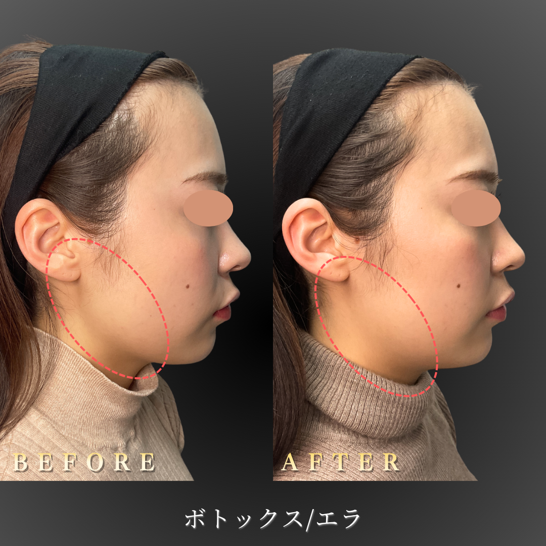 20代女性のエラボトックス症例写真 右側面 Before/After