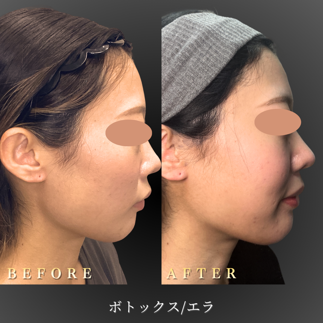 20代女性のエラボトックス症例写真右Before/After