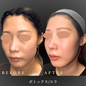 20代-エラボトックス-症例写真〔左45度Before_After〕｜大阪-心斎橋BiBiクリニック