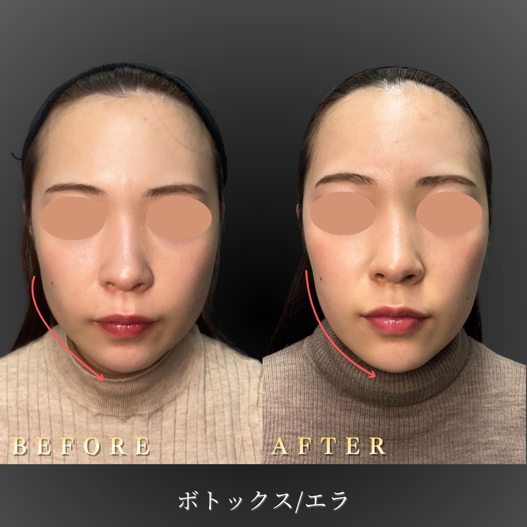 20代女性のエラボトックス症例写真 正面 Before/After