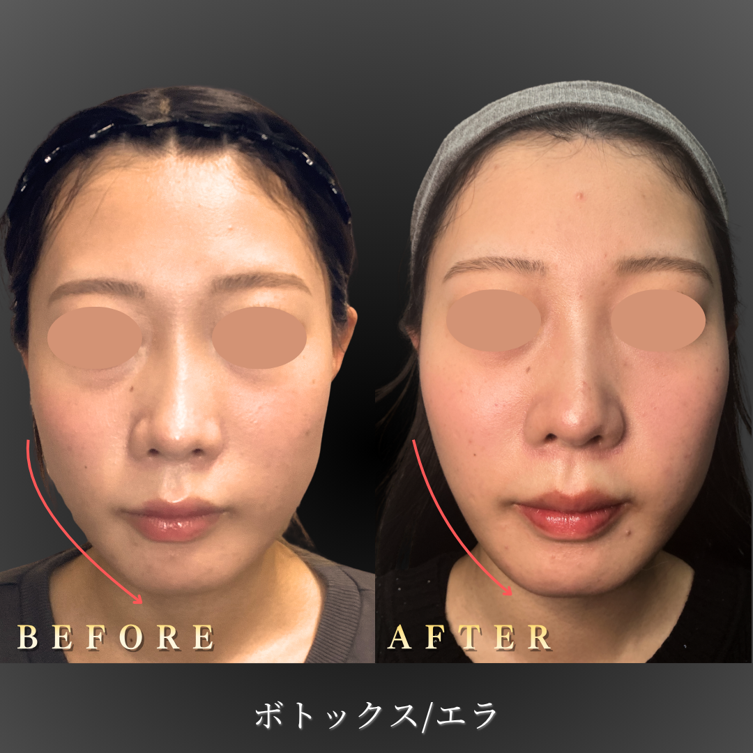20代女性のエラボトックス症例写真正面Before/After