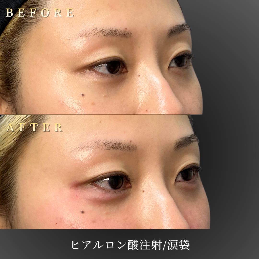 20代女性の涙袋ヒアルロン酸施術の45度角Before/After写真