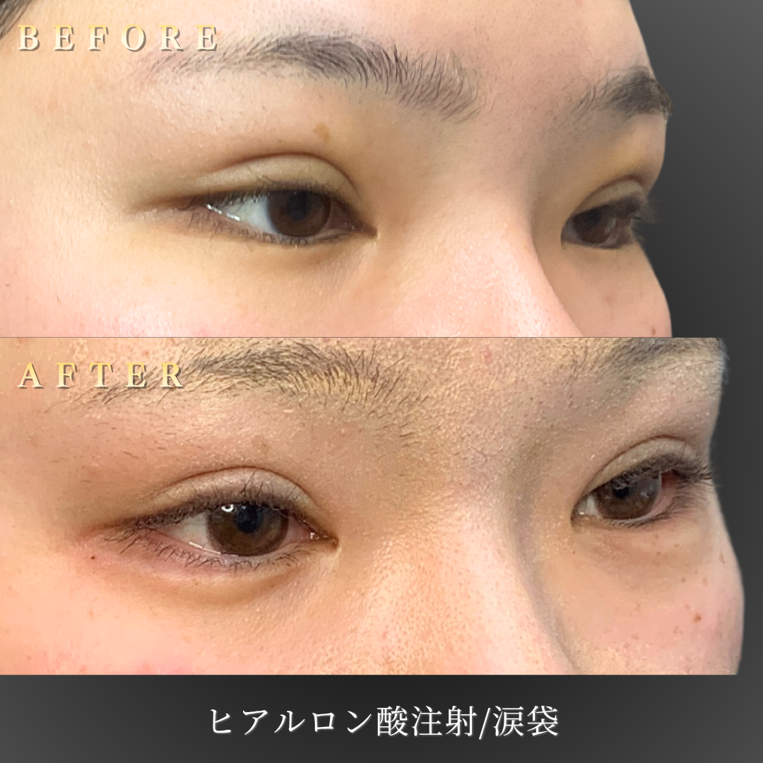 10代女性の涙袋ヒアルロン酸施術右斜め45度Before/After写真