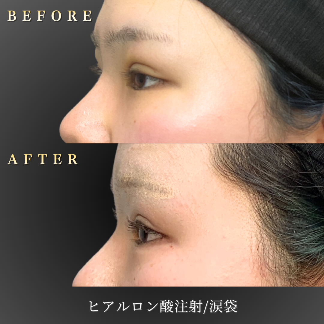 10代女性の涙袋ヒアルロン酸施術左横Before/After写真
