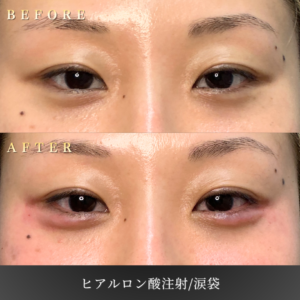 20代 涙袋ヒアルロン酸 症例写真〔正面Before_After〕｜大阪 心斎橋BiBiクリニック