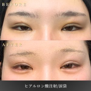 20代 涙袋ヒアルロン酸 症例写真〔正面Before_After〕｜大阪 心斎橋BiBiクリニック