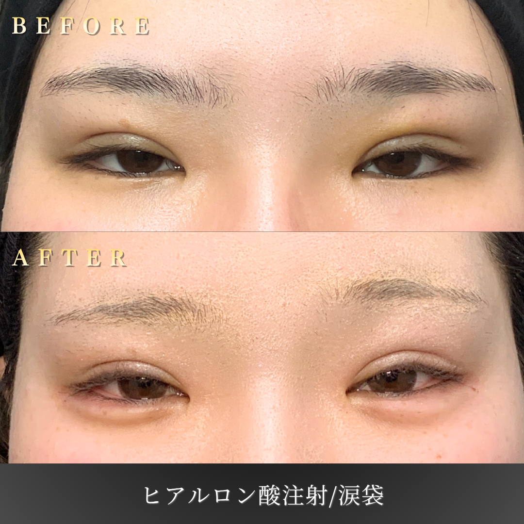 【10代女性】初めてでも安心な涙袋ヒアルロン酸症例｜大阪 心斎橋BiBiクリニックの症例写真