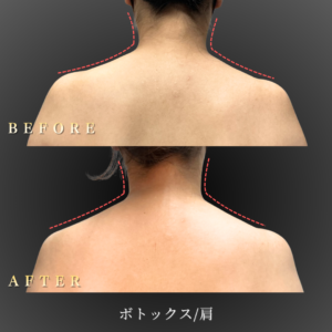 20代 肩ボトックス 症例写真〔正面Before_After〕｜大阪 心斎橋BiBiクリニック