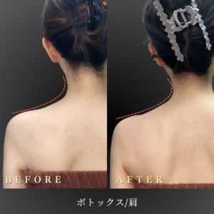 20代 肩ボトックス 症例写真〔背面Before_After〕｜大阪 心斎橋BiBiクリニック