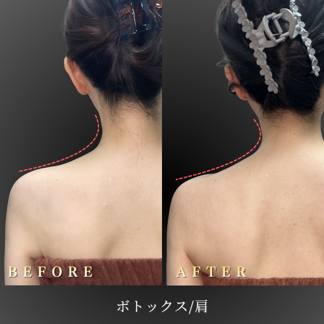 20代女性の肩ボトックス Before After 背面写真｜大阪・心斎橋BiBiクリニック