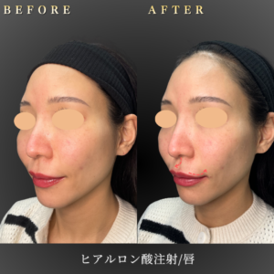 30代 唇ヒアルロン酸 症例写真〔左45度BeforeAfter〕｜大阪 心斎橋BiBiクリニック