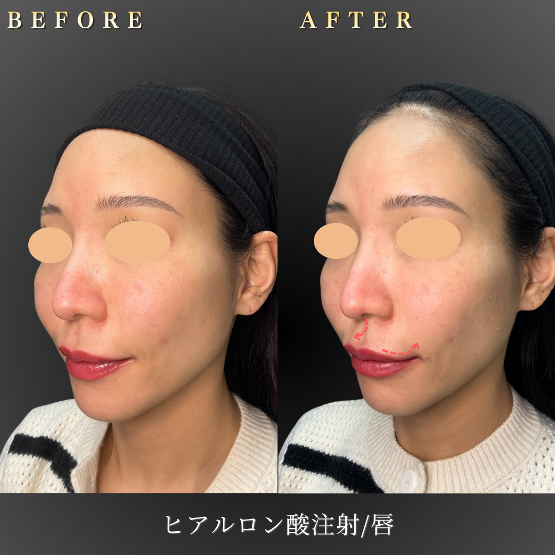 【30代女性】自然に若々しく見せる唇ヒアルロン酸症例｜大阪 心斎橋BiBiクリニックの症例写真