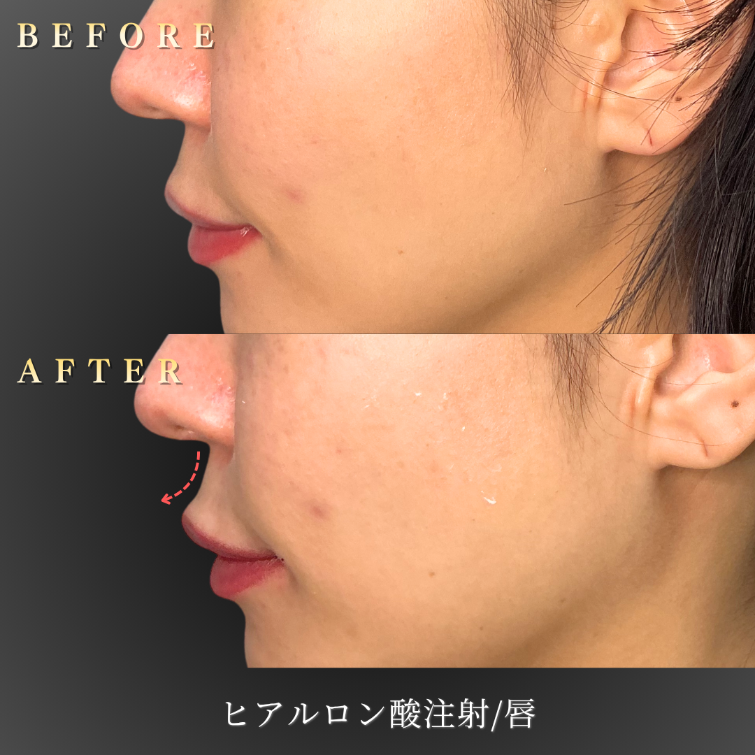 30代女性の唇ヒアルロン酸施術の左横BeforeAfter写真
