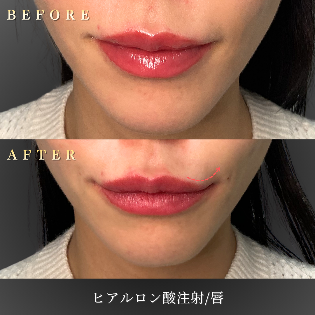 30代女性の唇ヒアルロン酸施術の正面BeforeAfter写真
