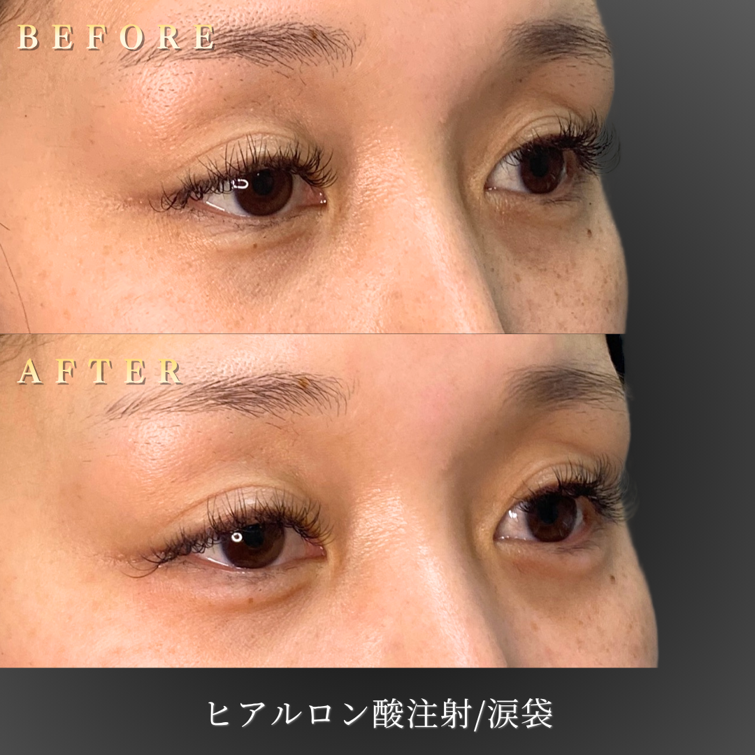 30代女性の涙袋ヒアルロン酸施術 右45度Before/After