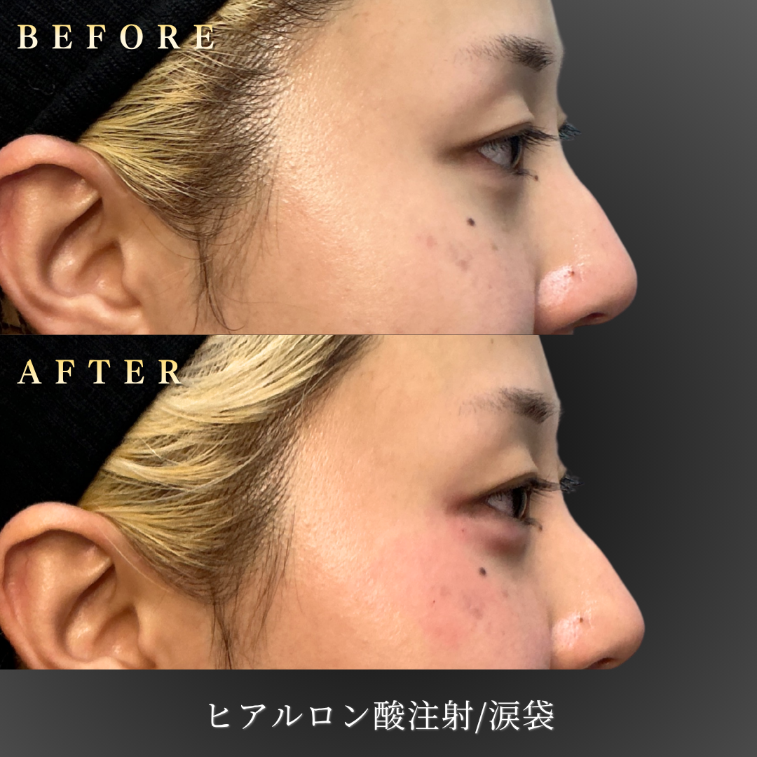 20代女性の涙袋ヒアルロン酸施術の横顔Before/After写真