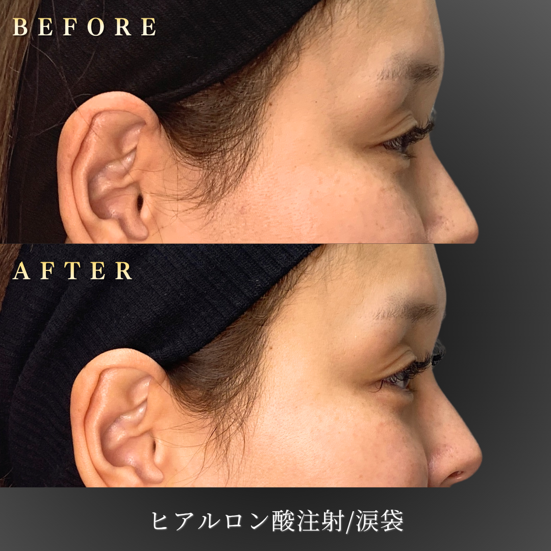 30代女性 涙袋ヒアルロン酸 右横Before/After