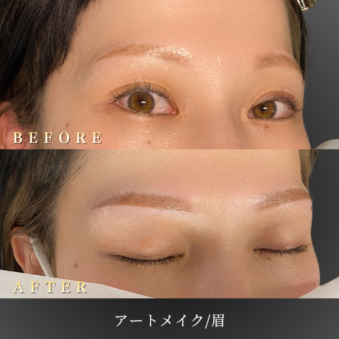 【30代女性】明るめ眉に仕上げる眉アートメイク症例｜大阪 心斎橋BiBiクリニックの症例写真