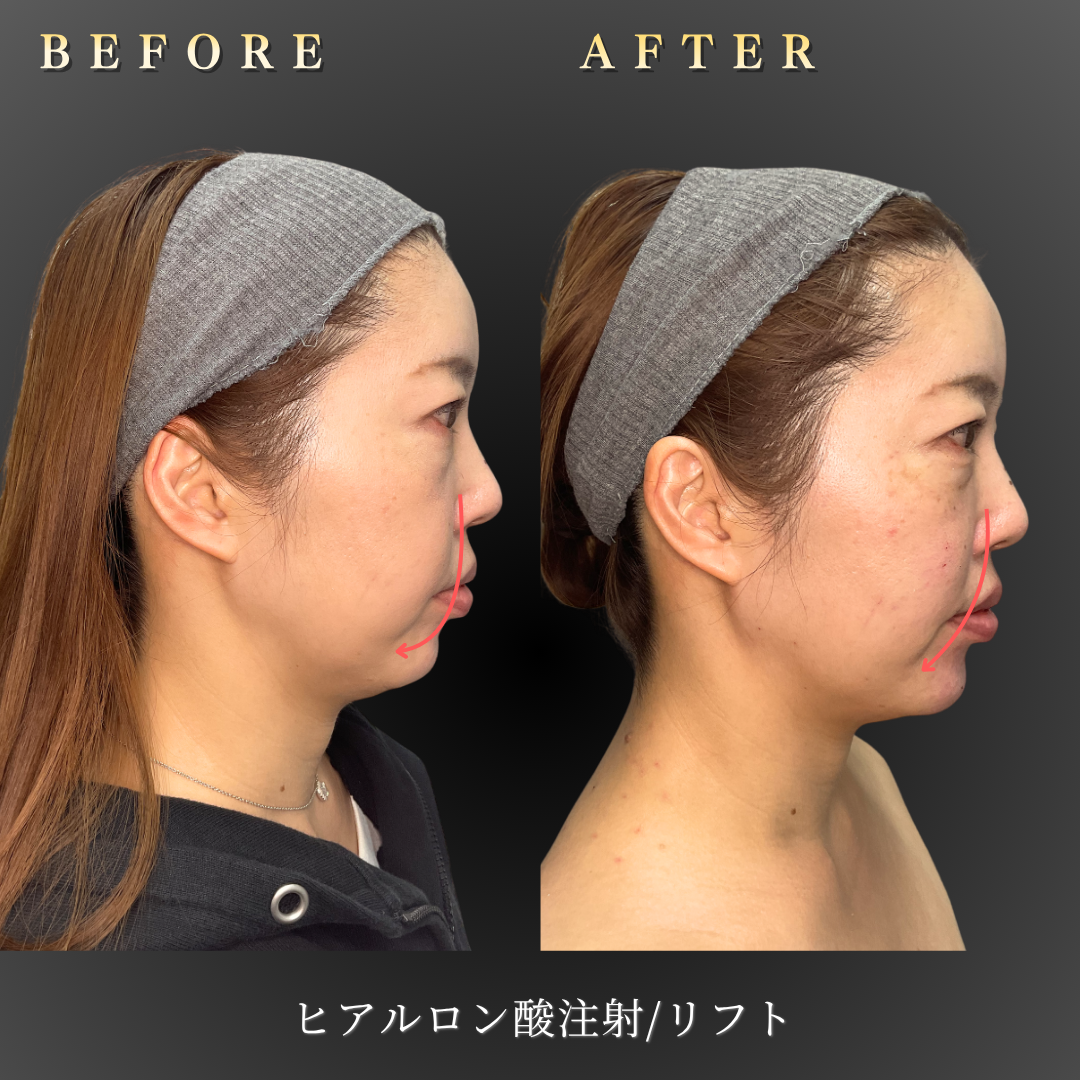 40代女性のヒアルロン酸リフト施術前後の右横顔写真