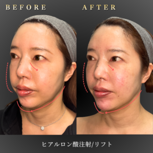 40代 唇ヒアルロン酸 症例写真〔左45度Before_After〕｜大阪 心斎橋BiBiクリニック