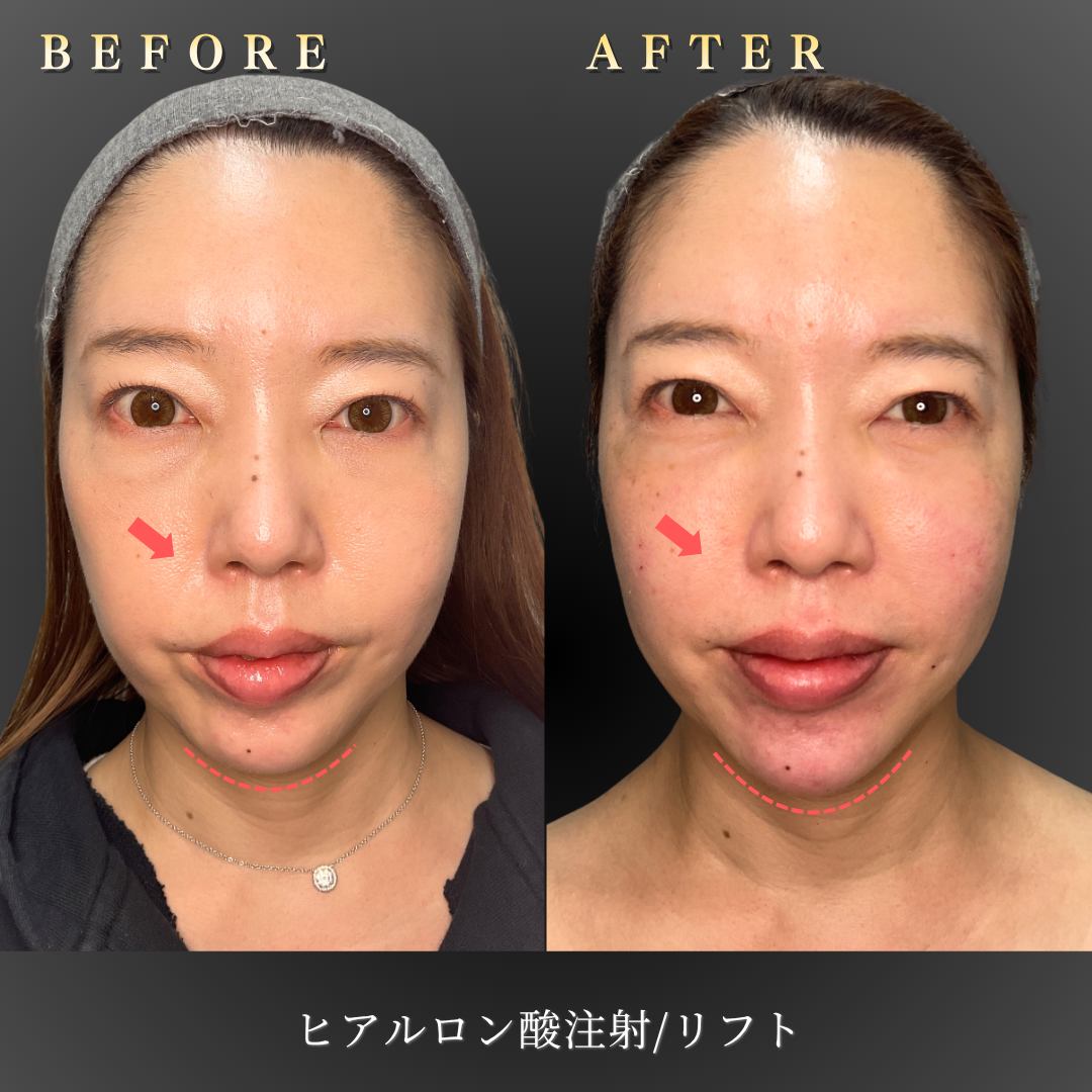 40代女性のヒアルロン酸リフト施術前後の正面顔写真