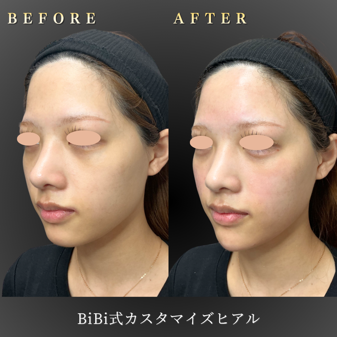 10代女性のBiBi式カスタマイズヒアルロン酸注入 左45度ビフォーアフター｜大阪・心斎橋BiBiクリニック