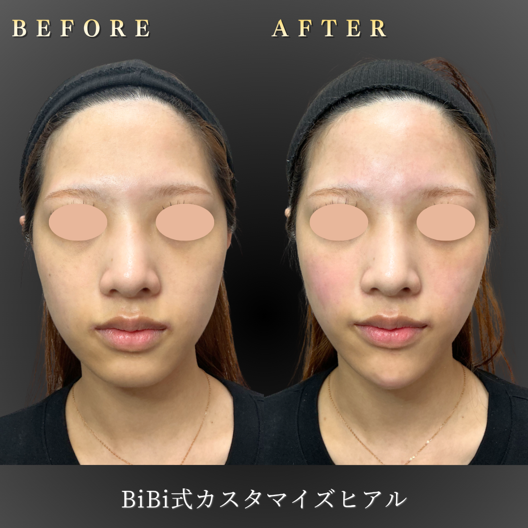 【10代女性】顔全体カスタマイズヒアル・Eライン形成｜大阪・心斎橋BiBiクリニックの症例写真