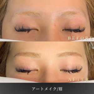 10代 眉アートメイク 症例写真〔正面Before_After〕｜大阪 心斎橋BiBiクリニック