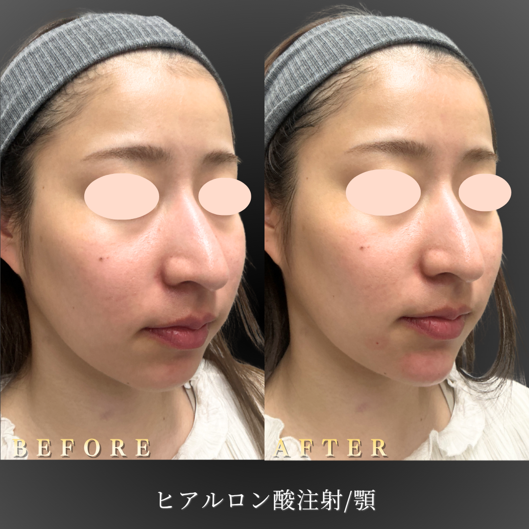 【20代女性】顎ヒアルロン酸でEライン・横顔を整える｜大阪・心斎橋BiBiクリニックの症例写真