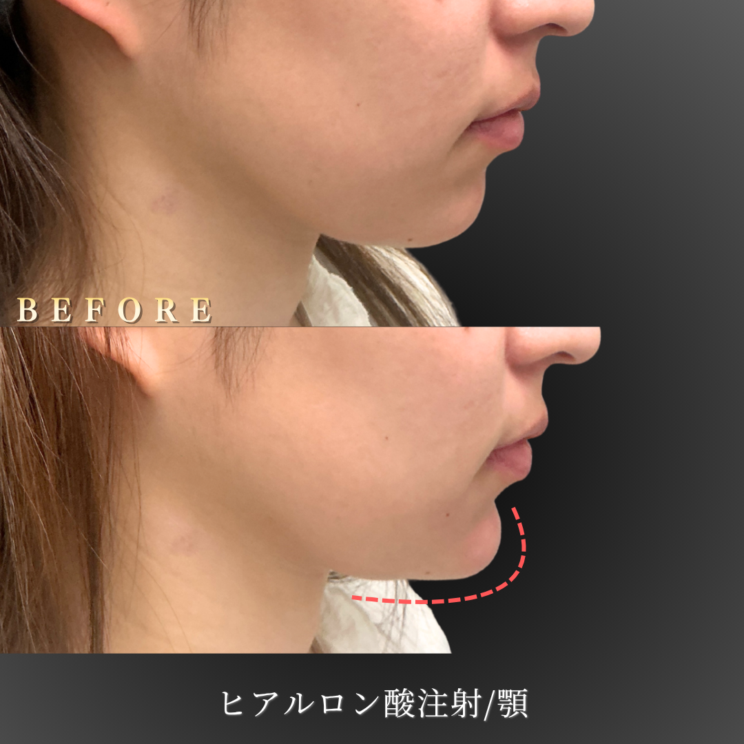 20代女性の顎ヒアルロン酸 右横顔 Before/After｜大阪・心斎橋BiBiクリニック