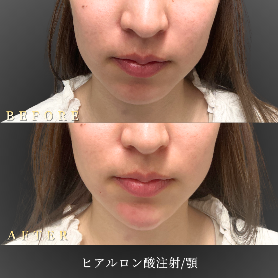 20代女性の顎ヒアルロン酸（ボラックス）施術 正面 Before/After｜大阪・心斎橋BiBiクリニック