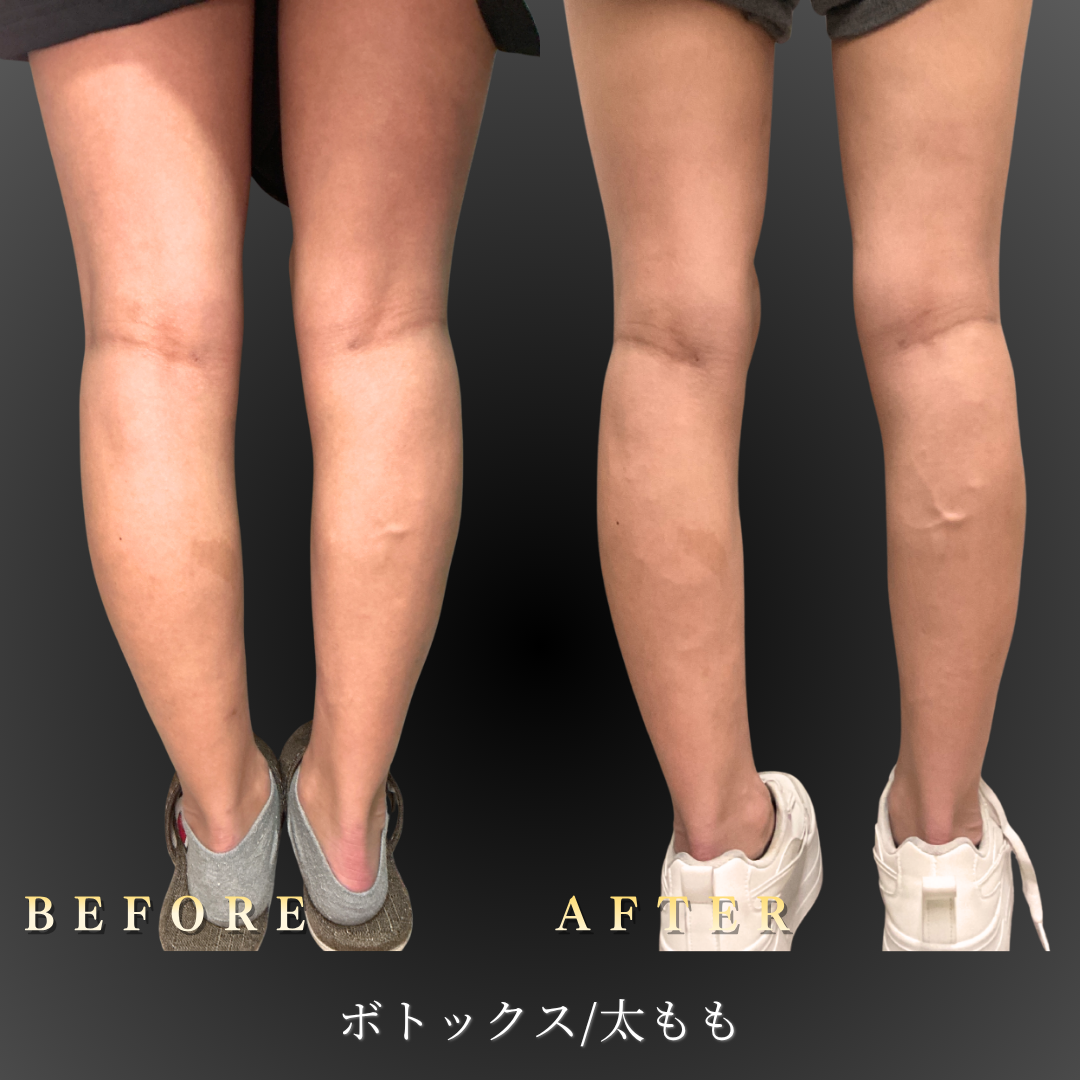 20代女性・太ももボトックス施術前後の背面比較写真」