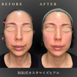 30代-カスタマイズヒアル-症例写真〔正面Before_After〕｜大阪-心斎橋BiBiクリニック3