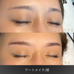 40代 眉アートメイク 症例写真〔右45度Before_After〕｜大阪 心斎橋BiBiクリニック