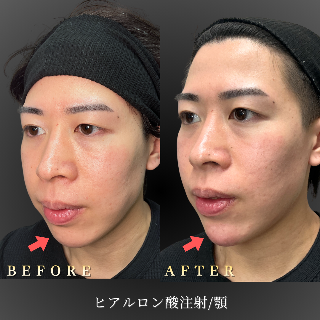 【20代男性】顎ヒアルロン酸でEラインを整えた症例｜大阪・心斎橋BiBiクリニックの症例写真